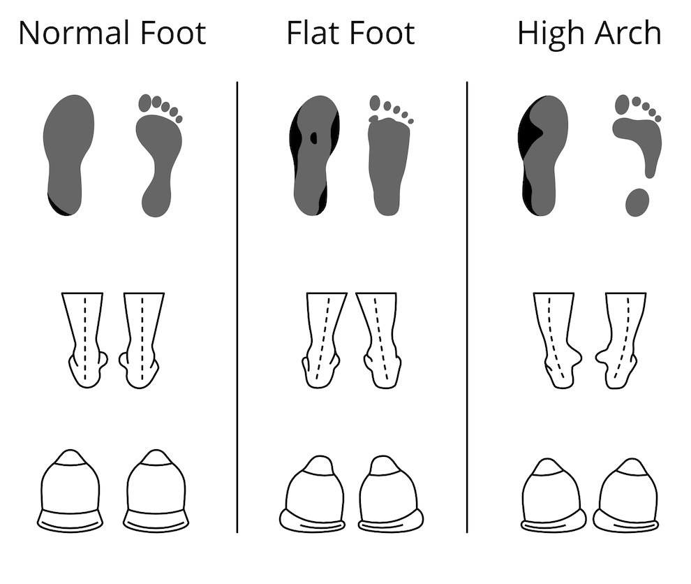 You can find insoles for normal arches, high arches and fallen arches You can find insoles for normal arches, high arches and fallen arches